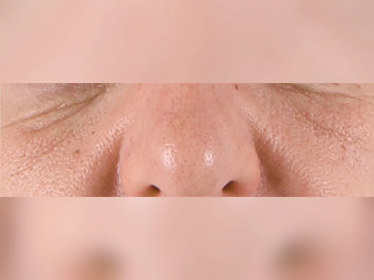 Enlarged pores, nose and cheeks, before treatment at London Real Skin