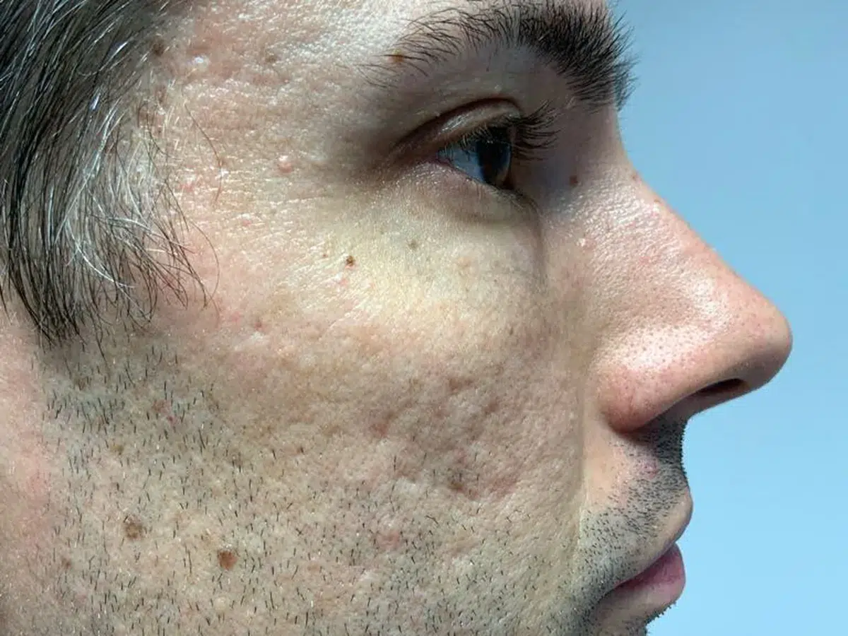 Texture and acne scarring on the cheek, before treatment at London Real Skin