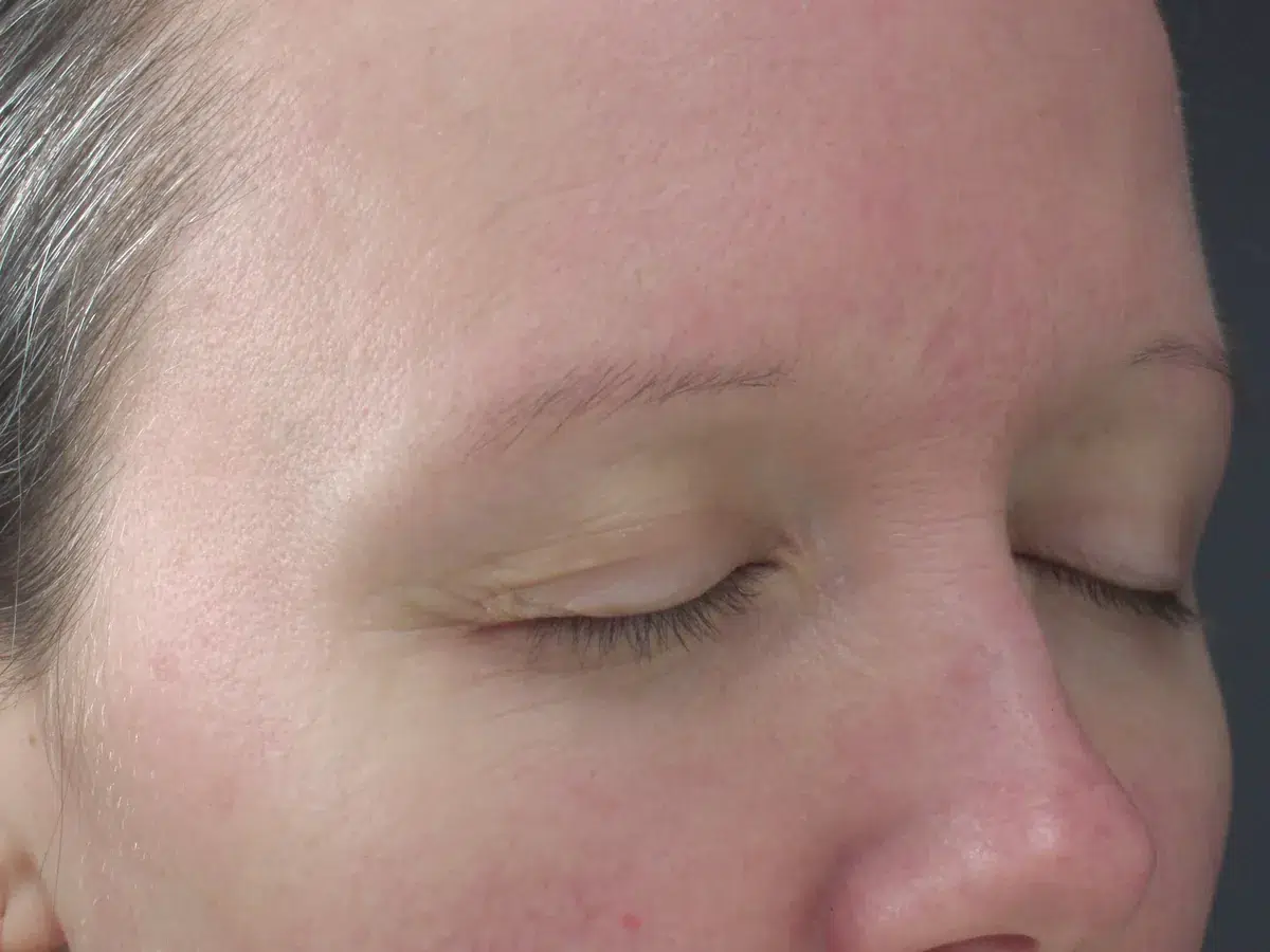 Facial redness across the cheeks, before treatment at London Real Skin