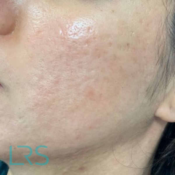 Micro-needling results