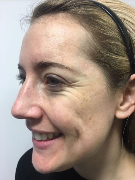 Botox Female - Before 400