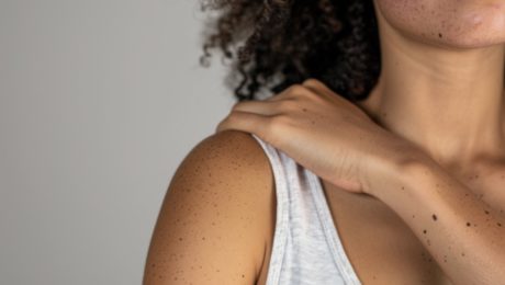 Cosmetic treatments for moles