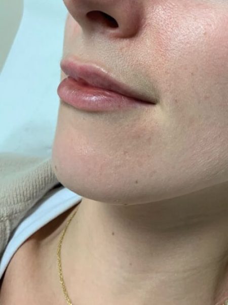 lip filler before (1)