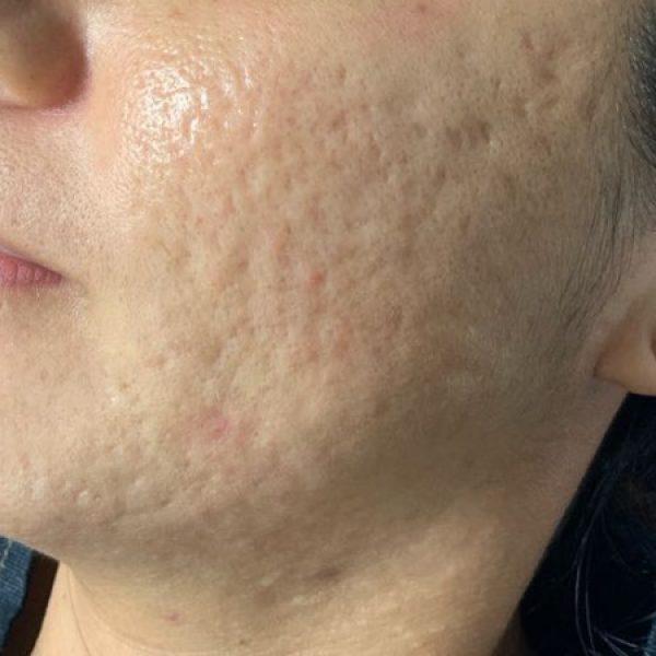 microneedling acne before